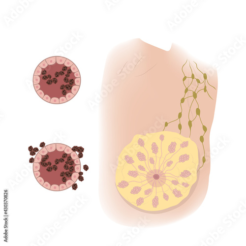 Woman breast. Ductal cancer. In situ, Invasive. Medical vector illustration.