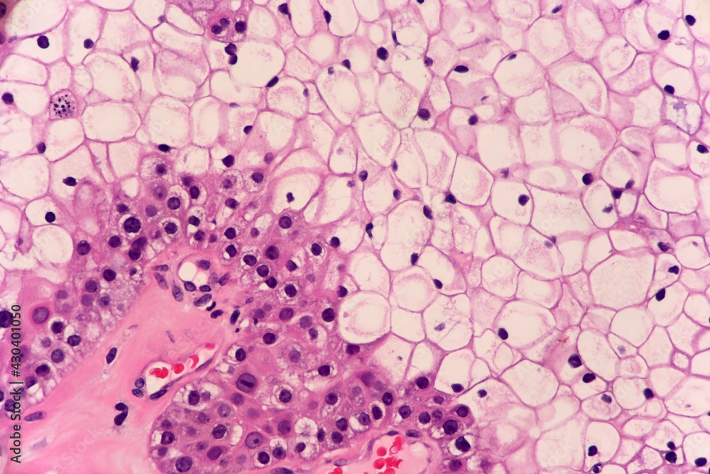 Benign skin tumor called clear cell hidradenoma. Notice the large cells with tiny dark nuclei and clear cytoplasm. Microscopic view. Benign skin tumor called clear cell hidradenoma. Notice the large cells with tiny dark nuclei and clear cytoplasm. Microscopic view.