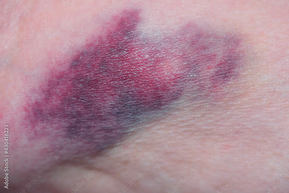 Fototapeta premium bruise on a woman's hand