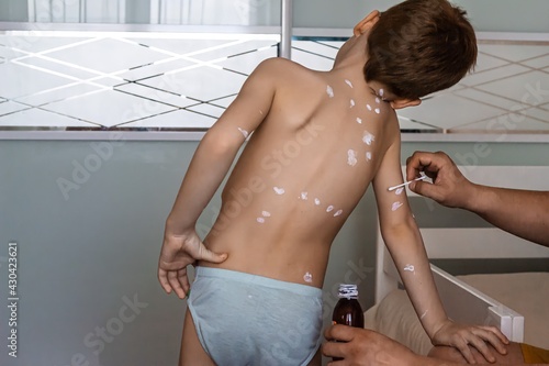 Chickenpox treatment concept, relieving disease symptoms with white anti-itch cream, paternal care photo