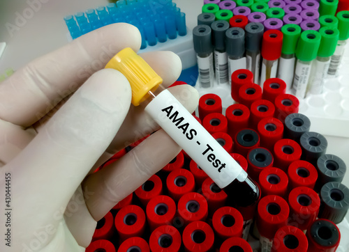 Blood sample for Anti Malignin Antibody (AMAS), Tumor marker. diagnosis of cancer photo