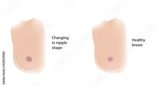 Woman healthy breast and Changing in nipple shape. Comparison. Medical vector illustration.