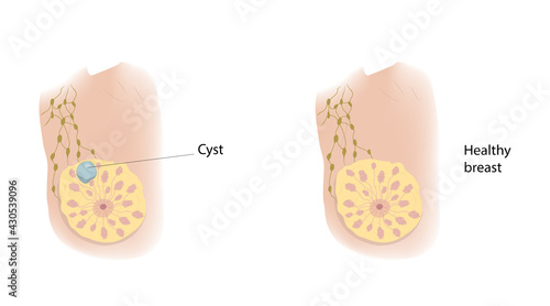 Woman healthy breast and cyst. Comparison. Medical vector illustration.