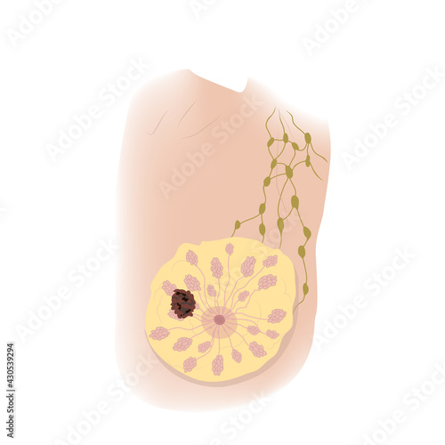 Woman breast. Cancer T2. Medical vector illustration.