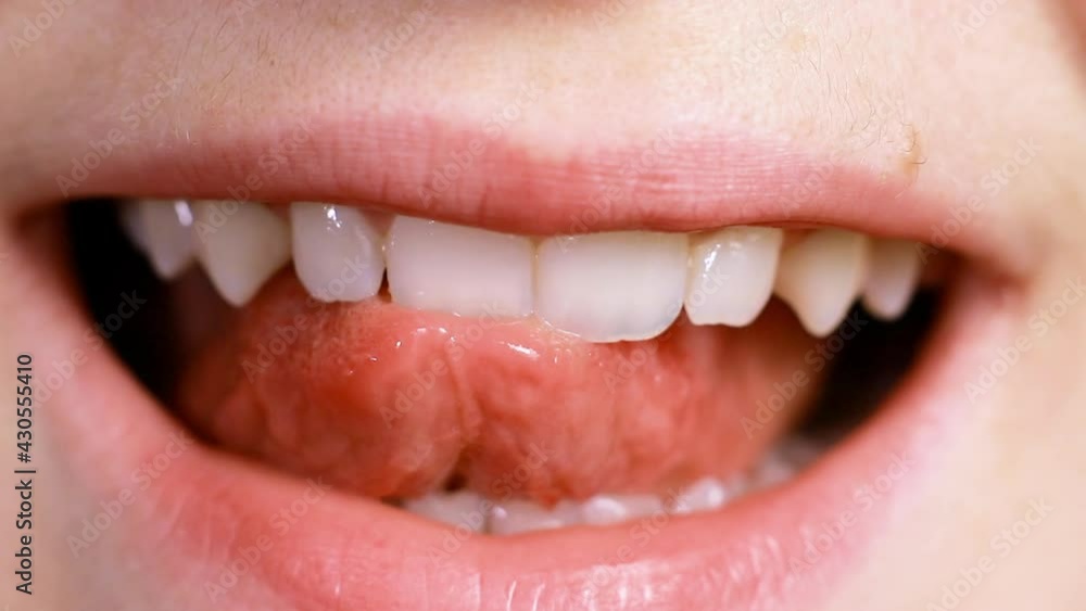 Macro video of a man smiling, shows the tongue chipped tooth. The