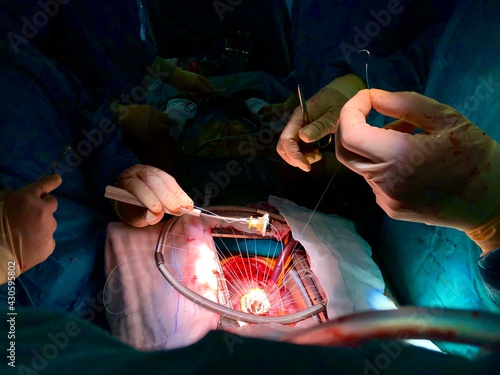 Aortic valve replacement (AVR) with mechanical valve. Open heart surgery with cardiopulmonary bypass. photo
