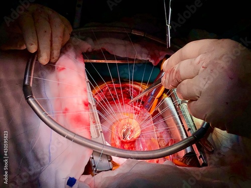 Canvastavla Aortic valve replacement (AVR) with mechanical valve
