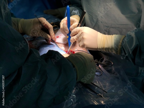 Surgeon was puncture to femoral artery by arterial cutdown technique. photo