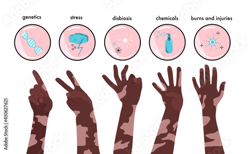 World vitiligo day.Infographics icons with reasons of sickness.Afro american hands with skin disease.Gestures show 1,2,3,4,5 fingers.Pigmentation problem.Patchy loss of derma color.  Stress and burns