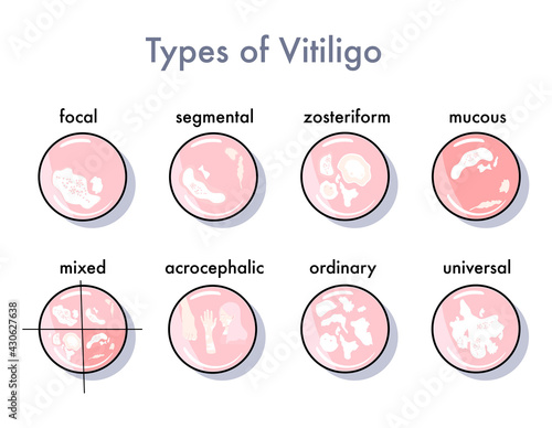 Types of vitiligo infographic icons Options for the spread and manifestation of the skin disease.Pigmentation problem.Patchy loss of derma color.   Vector in flat style. Psoriasis. Medical banner