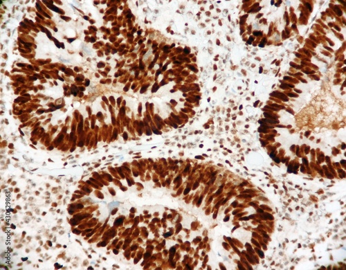 Bild auf Leinwand Malignant glands of a colon cancer with strong brown expression of the mismatch repair protein called MSH2
