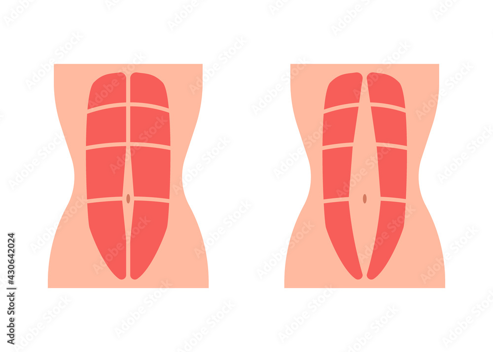 Normal tone muscle abdomen and diastasis recti, weak and divergence ...