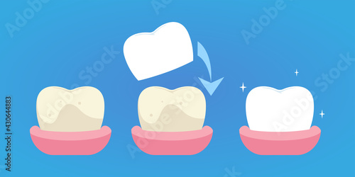 Restoration of a tooth, installation of a crown, installation dental veneers.
