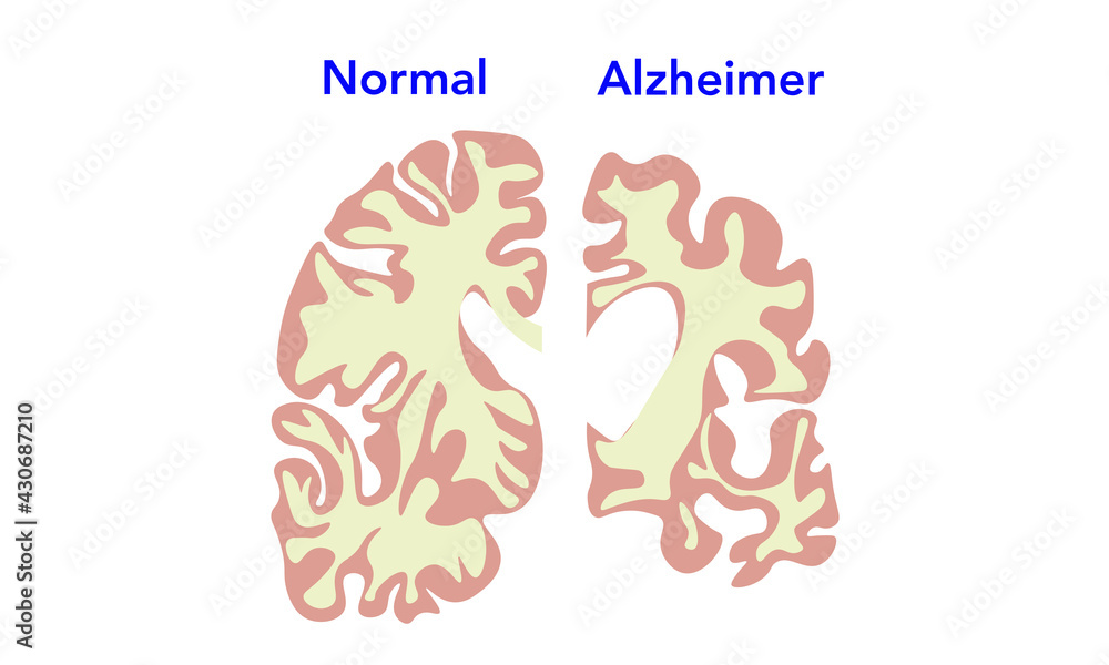 Alzheimer's ventricles [Brain]