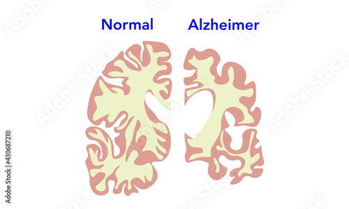 Alzheimer's ventricles [Brain]