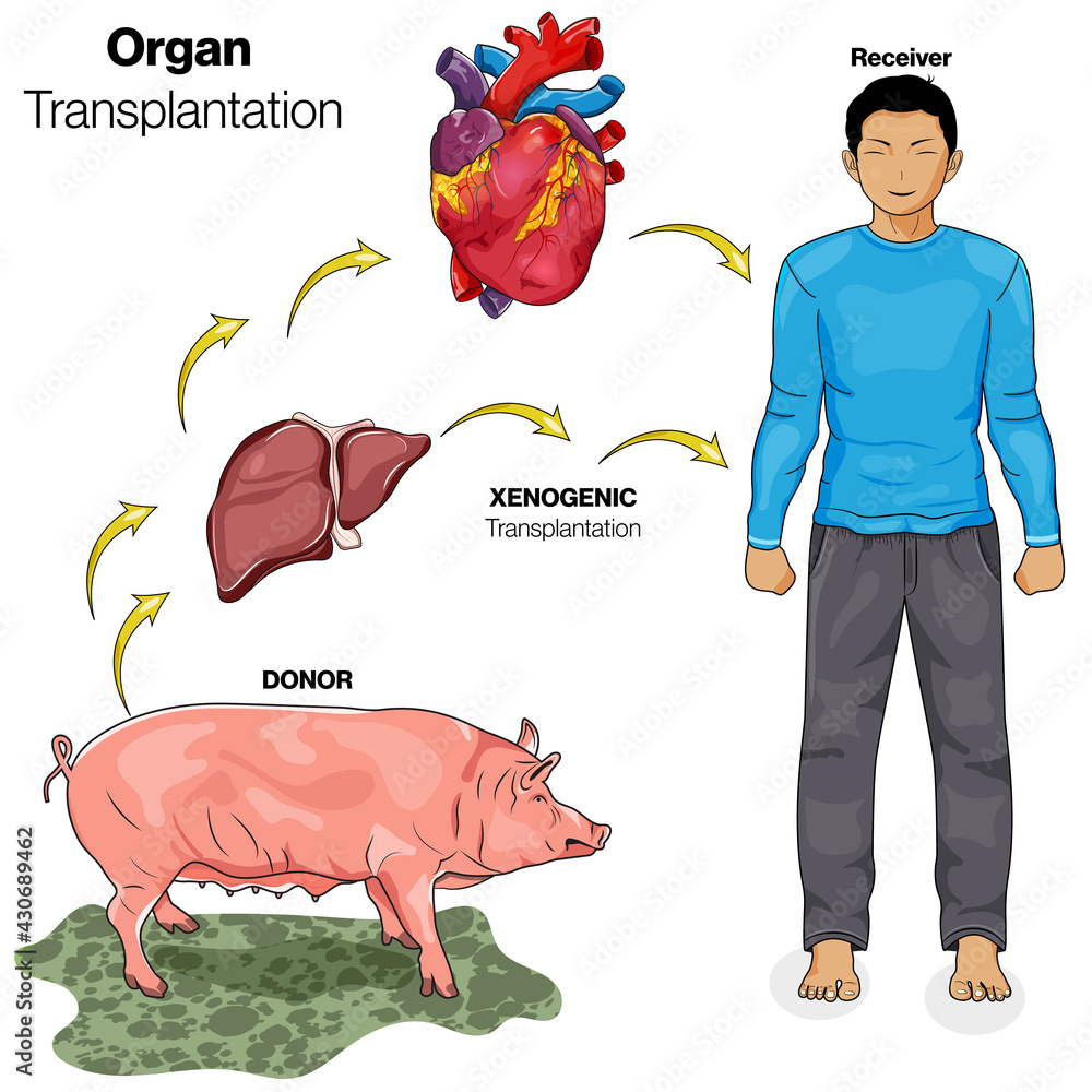 illustration of xenogeneic or xenograft organ transplantation from Pig