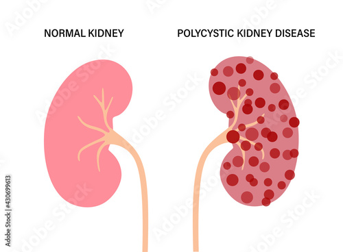 Kidney disease concept