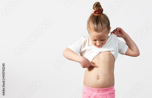 Картината върху платно Portrait of a little child girl with chickenpox