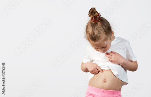 Obraz na plátně Portrait of a little child girl with chickenpox