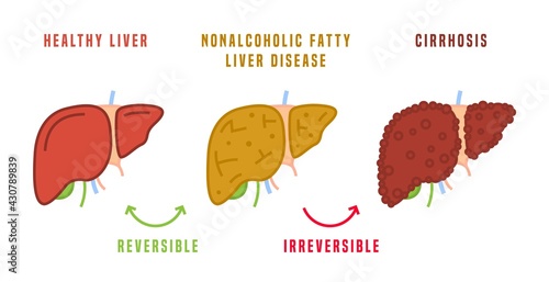 Stages of liver diseases. Medical infographic. Vector illustration
