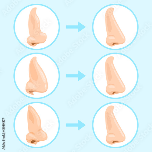 Cartoon rhinoplasty surgery. Rhinoplasty before and after, nose plastic surgery result. Rhinoplasty surgery infographic vector illustration set