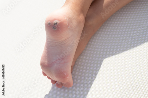 Group of warts on the patient's heel. White background. Macro. Closeup. Concept for treatment of viral warts in children, hygiene, human skin disease. Copy space.
