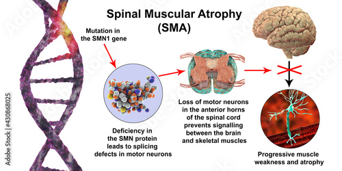 фотографія Spinal muscular atrophy, SMA, a genetic neuromuscular disorder with progressive