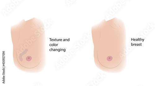 Woman healthy breast and Texture and color changing. Comparison. Medical vector illustration.