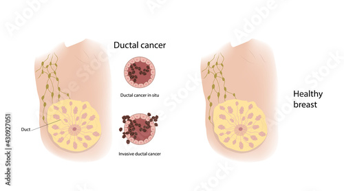 Woman healthy breast and ductal cancer. Comparison. Medical vector illustration.