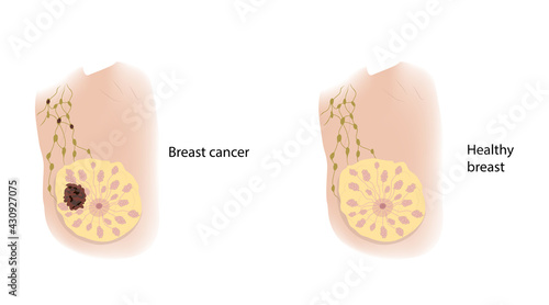 Woman healthy breast and cancer. Comparison. Medical vector illustration.