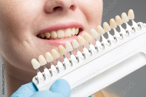 Close up of dentist using shade guide at woman's mouth to check veneer of teeth for bleaching 