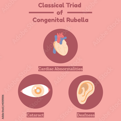 Classical Triad of Congenital Rubella