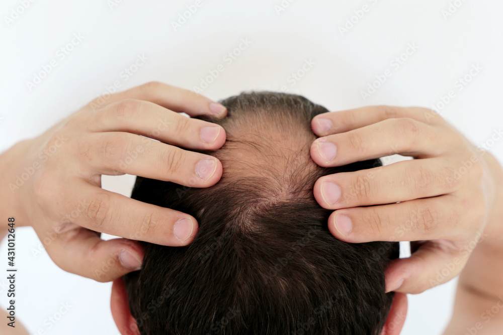 Fototapeta premium Beginning to go bald man concerned about hair loss. Male head with a bald on white background
