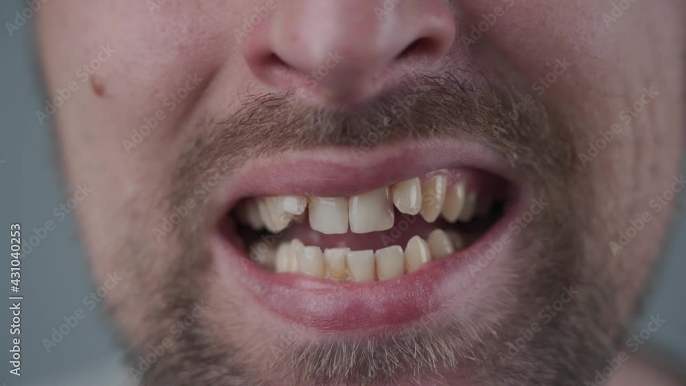 Dental displacement. Male mouth with crooked teeth and malocclusion. Crowding of teeth of the upper jaw. Orthodontics. Overcrowded teeth, abnormal dental occlusion. Teeth before install braces Dental displacement. Male mouth with crooked teeth and malocclusion. Crowding of teeth of the upper jaw. Orthodontics. Overcrowded teeth, abnormal dental occlusion. Teeth before install braces