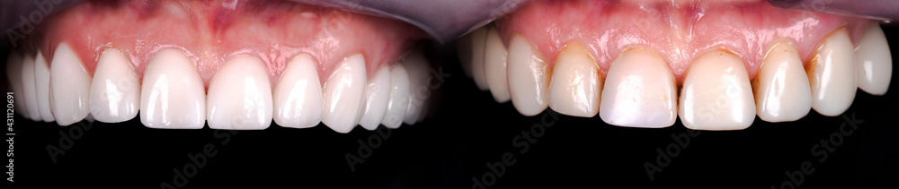 Fototapeta premium Perfect smile before and after veneers bleach of zircon arch ceramic prothesis Implants crowns. Dental restoration treatment clinic patient . Adult old woman surgery procedure whitening dentistry