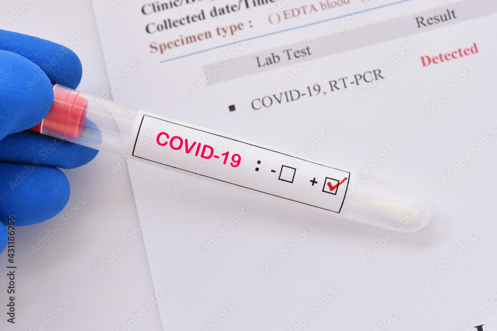 Nasopharyngeal swab positive with COVID-19 test by using RT-PCR method 