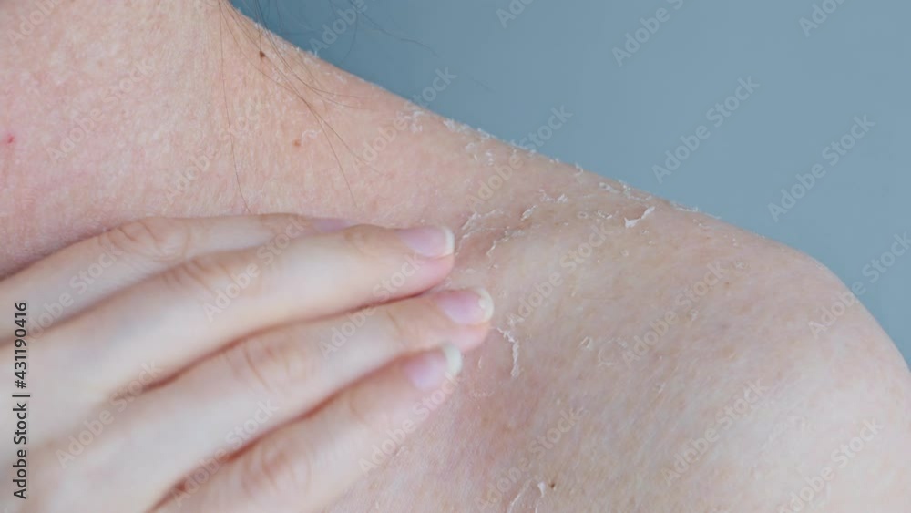 Itching of damaged skin. The woman scratches the skin on her shoulder, which is covered with scabs, with her nails, the dry skin is exfoliated. Problem skin. Body care. Close-up. Itching of damaged skin. The woman scratches the skin on her shoulder, which is covered with scabs, with her nails, the dry skin is exfoliated. Problem skin. Body care. Close-up.