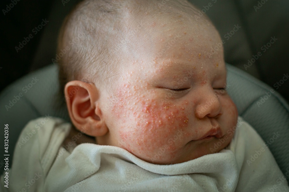 A Newborn Baby Suffering From Baby Acne Cradle Cap And Eczema On The 