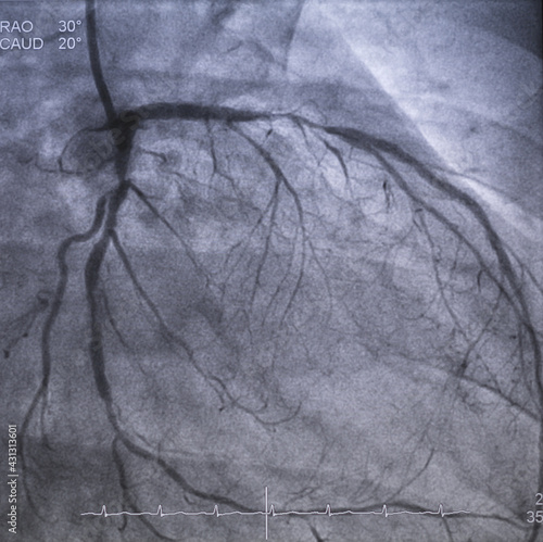 Coronary angiogram (CAG) was performed left anterior descending artery (LAD) stenosis. photo
