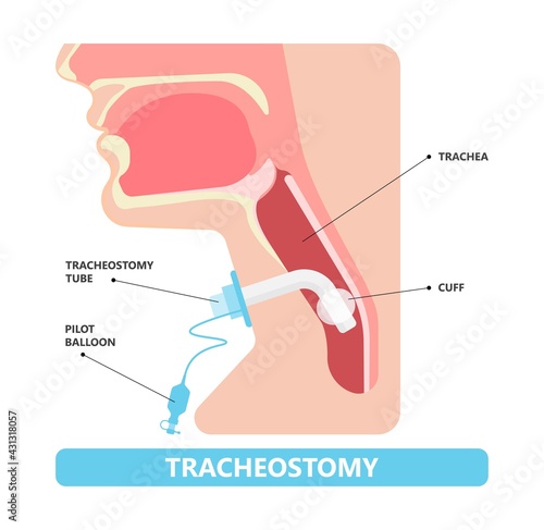 tube oxygen lungs face mask airway breathing trachea neck machine medical surgery ICU care unit ARDS Acute edema nursing suction catheter injury stoma disease coma obstructive sleep apnea blocked 19