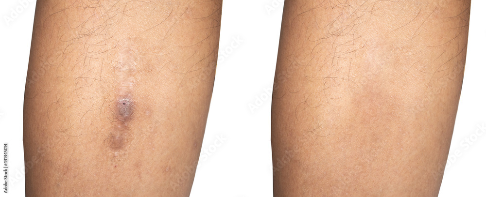 Before and after the scar after the treatment Rehabilitation of wounds from accidents, burns, dermatitis. Before and after the scar after the treatment Rehabilitation of wounds from accidents, burns, dermatitis.