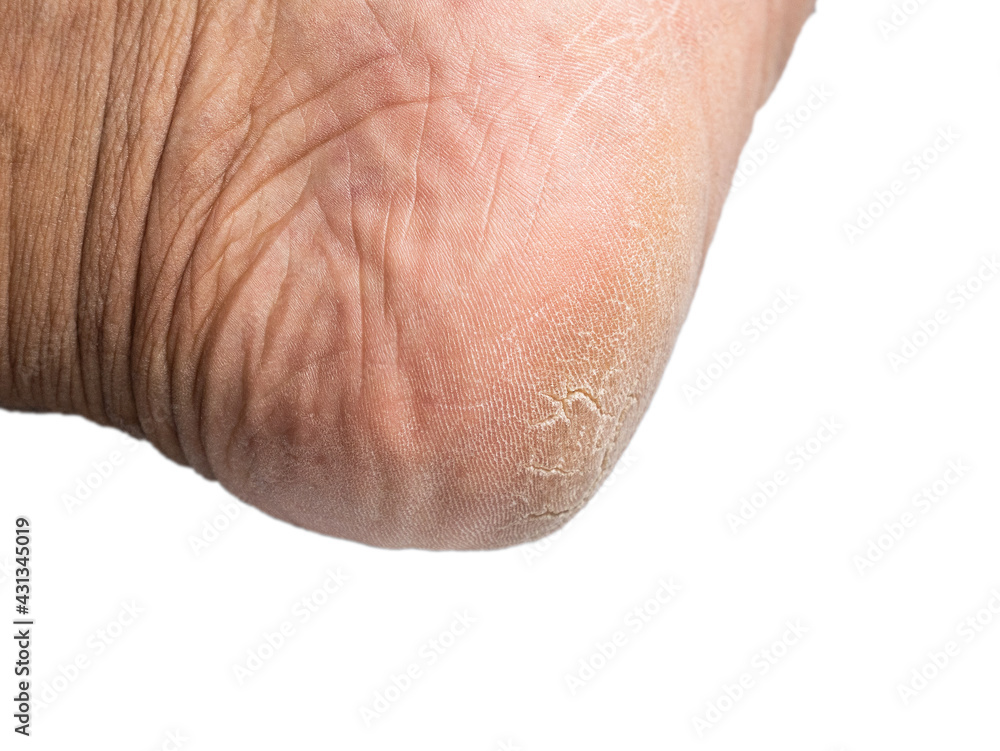 Close up of Cracks on Heels, Dry heels, dehydrated skin on Asian man heels isolated on white background Close up of Cracks on Heels, Dry heels, dehydrated skin on Asian man heels isolated on white background