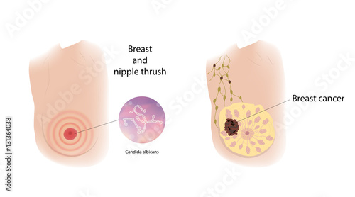 Woman breast and nipple thrush and Cancer. Comparison. Medical vector illustration.