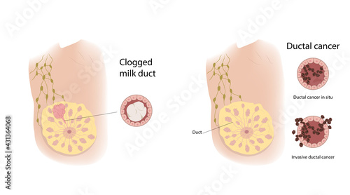 Woman breast. Clogged milk duct and ductal cancer. Comparison. Medical vector illustration.