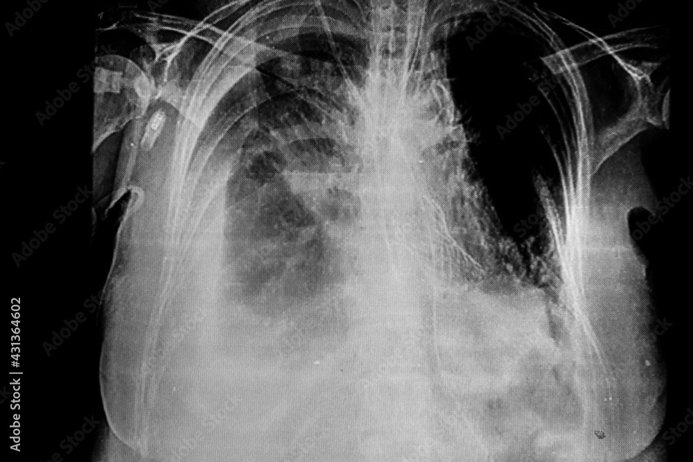 Portable chest X -ray showing right pleural effusion endotracheal tube ...