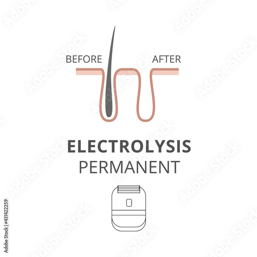 Electrolysis permanent for hair removal before after a vector illustration.