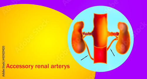 Accessory renal arteries