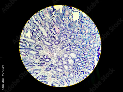 Colon Cancer: Photomicrograph (microscopic image) of colonic adenocarcinoma,Light microscope 200x showing colon adenocarcinoma photo