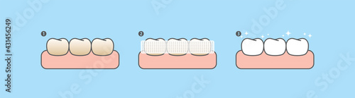 Step of whitening teeth by teeth whitening strips. illustration vector design on blue background. Dental care concept.