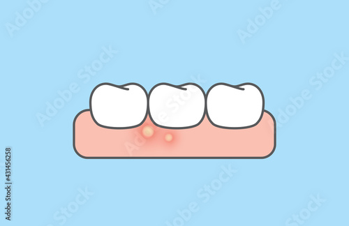 The gumboil and white teeth. illustration vector design on blue background. Dental care concept.
